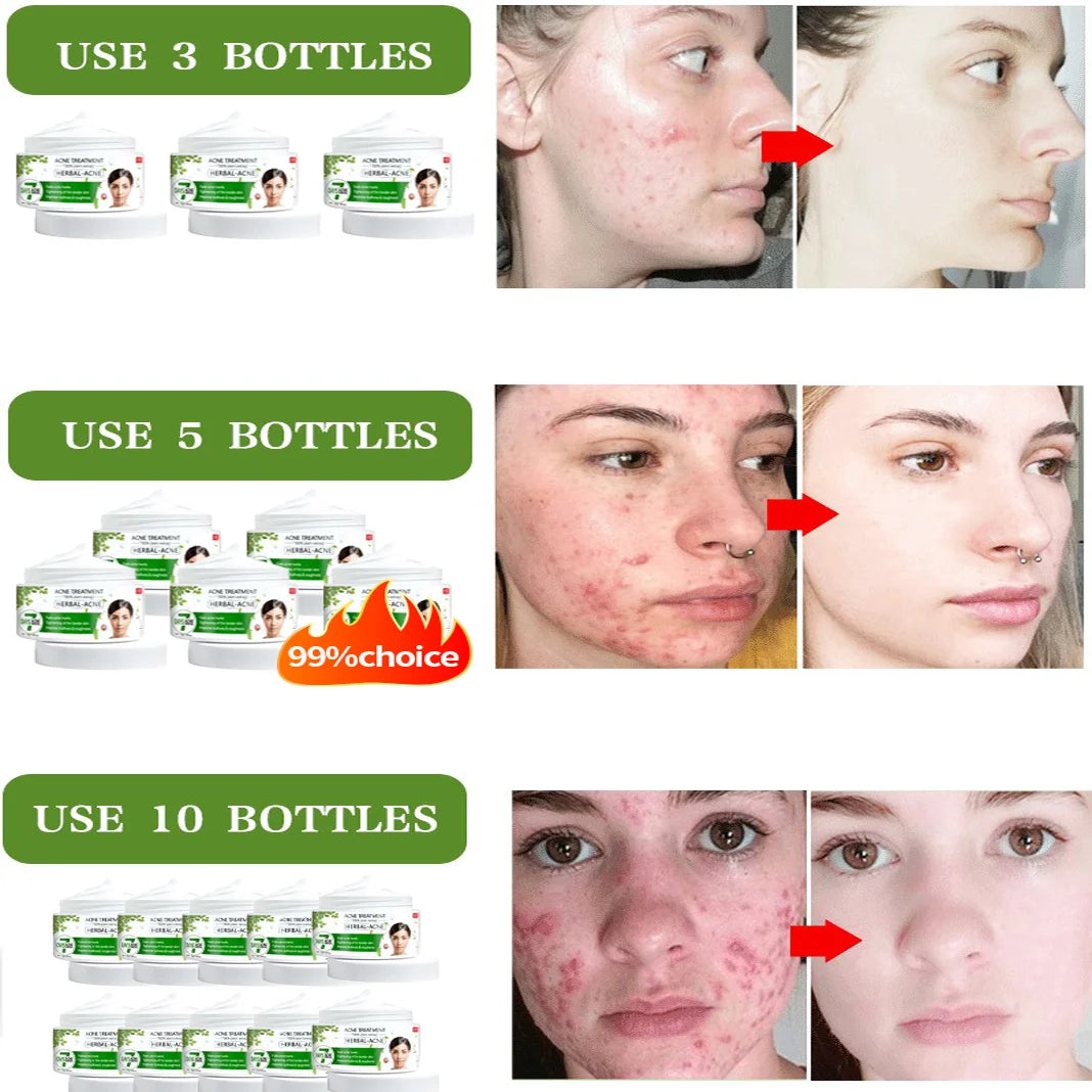 Acne Cream Herbal Essence Anti-Inflammatory, Anti-Acne, Anti-Acne, Anti-Acne, Oil Control, Suitable for All Kinds of Acne